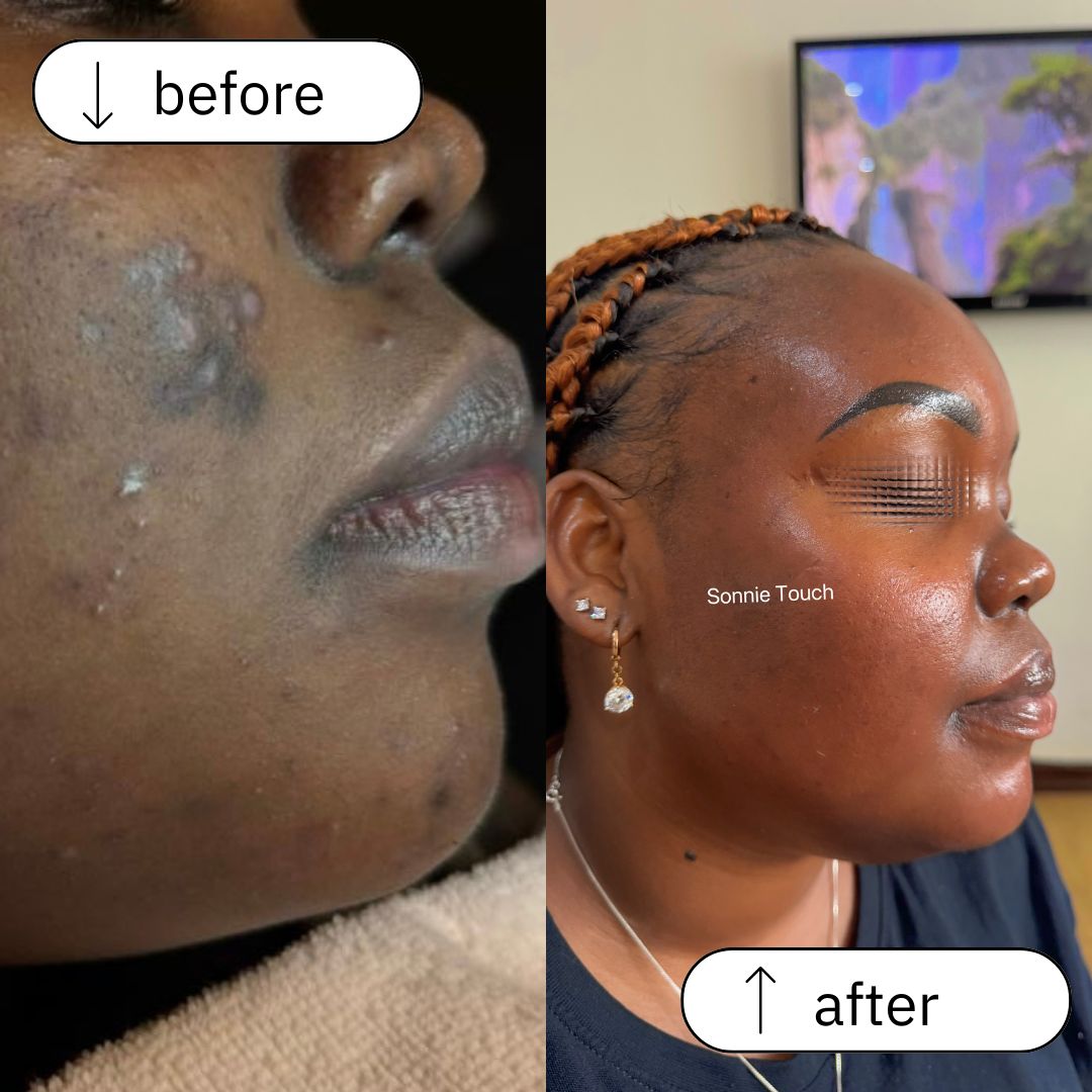 Acne & Dark Spot Treatment (1)