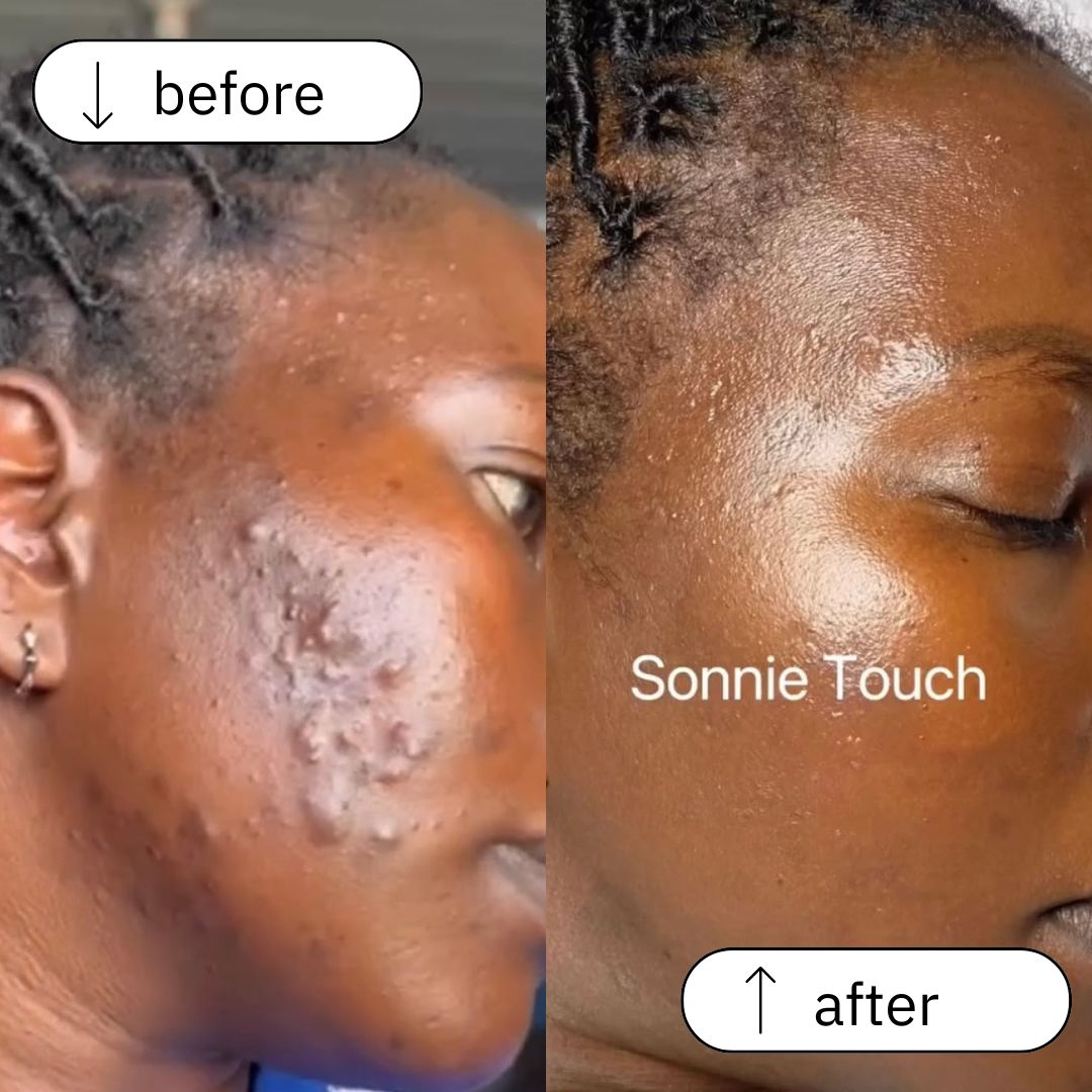 Acne & Dark Spot Treatment (3)