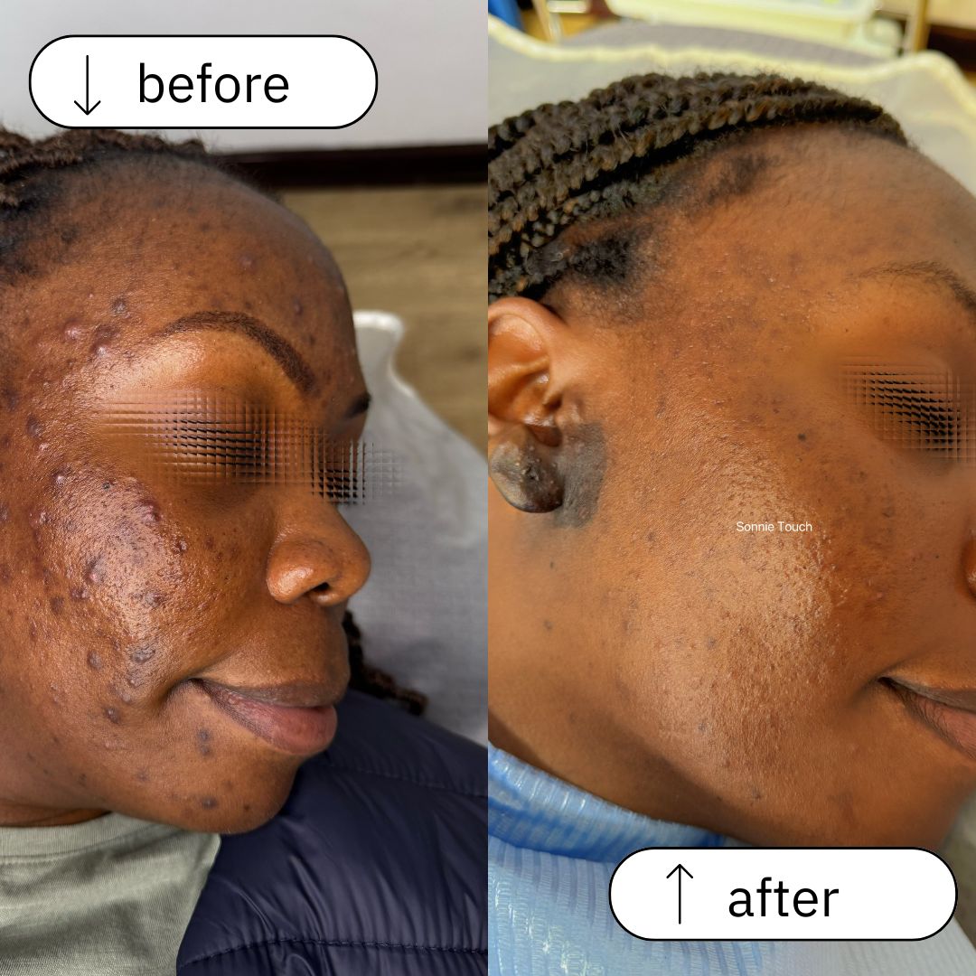 Acne & Dark Spot Treatment
