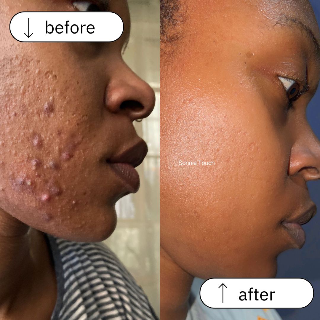 Acne before and after