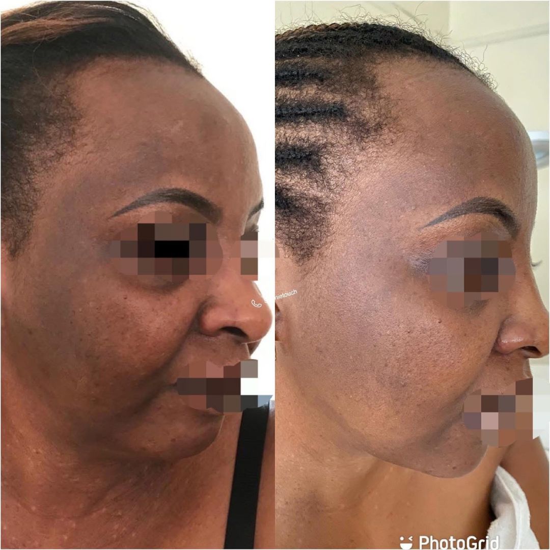 Hyperpigmentation before and after (1)