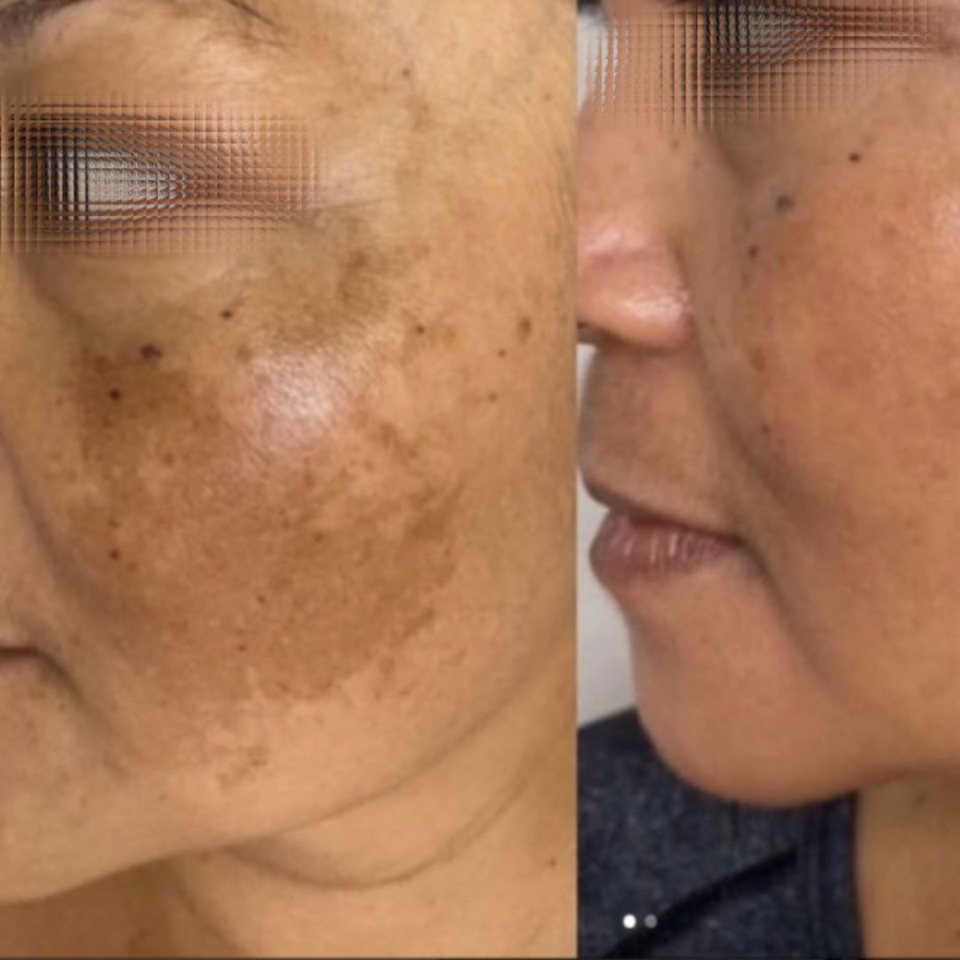 Hyperpigmentation before and after (2)