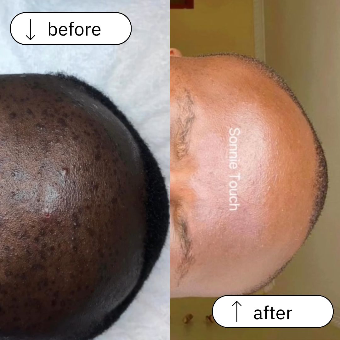 Hyperpigmentation before and after (3)