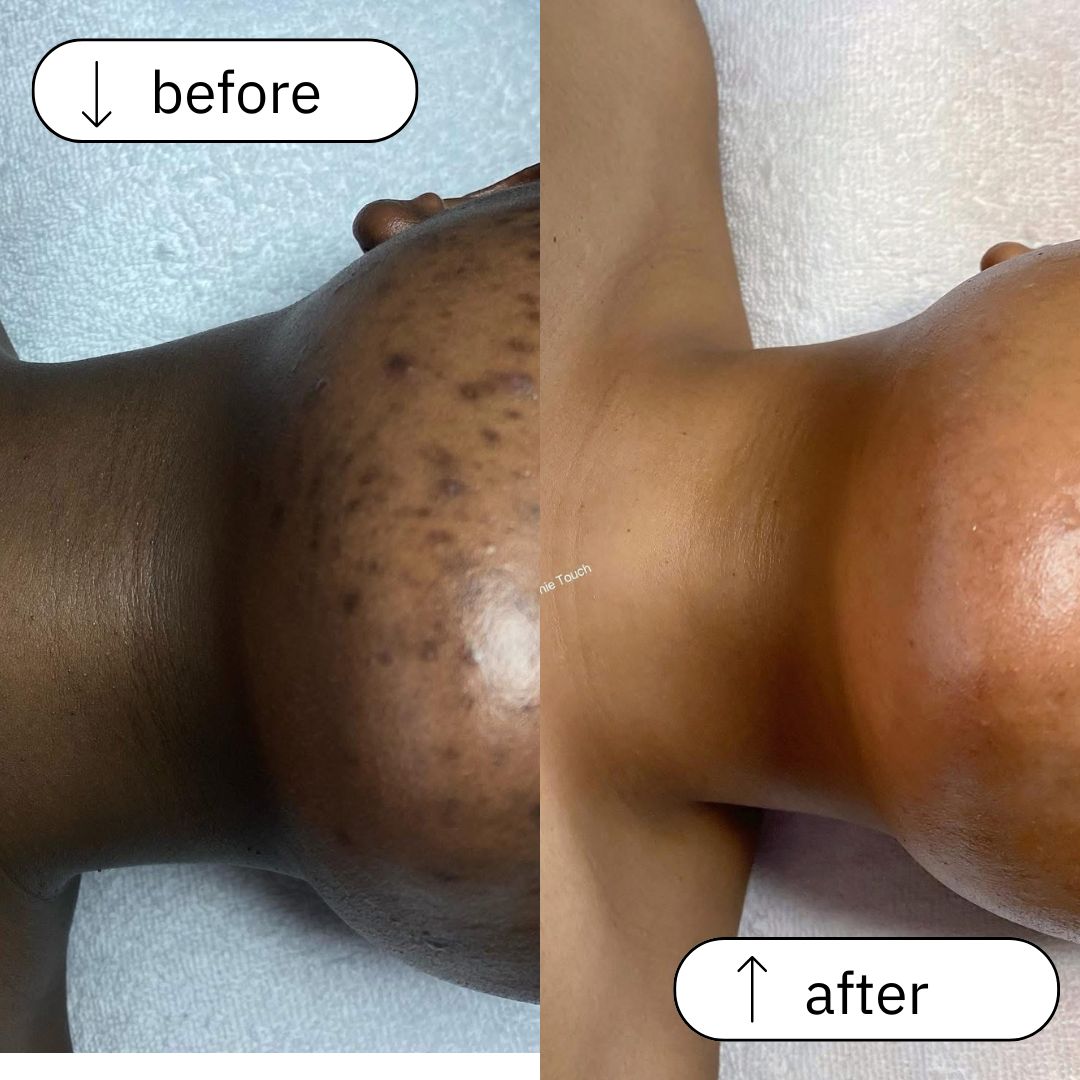 Hyperpigmentation before and after